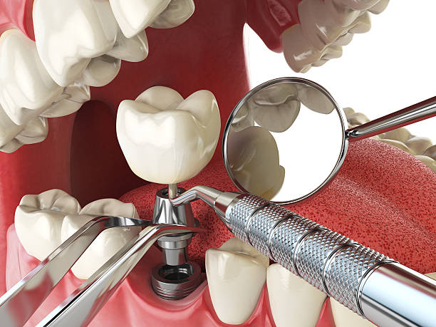 Best Emergency Dentist for Knocked-Out Tooth in Valley Stream, NY